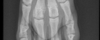 Clinical tip: Metacarpal and metatarsal fractures "spider frame"