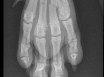 Clinical tip: Metacarpal and metatarsal fractures "spider frame"